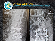 APSS Anterior Column Reconstruction Focus Group Webinar 2023